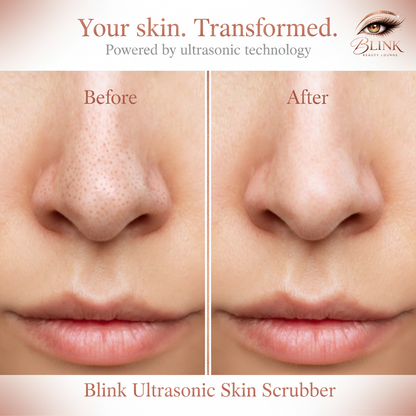 Blink SkinSpa Pro™ | Ultrasonic Deep Pore Cleansing Device